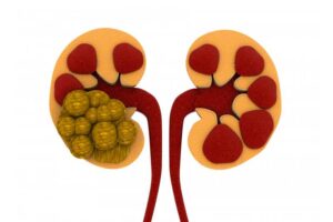 kidney-stones